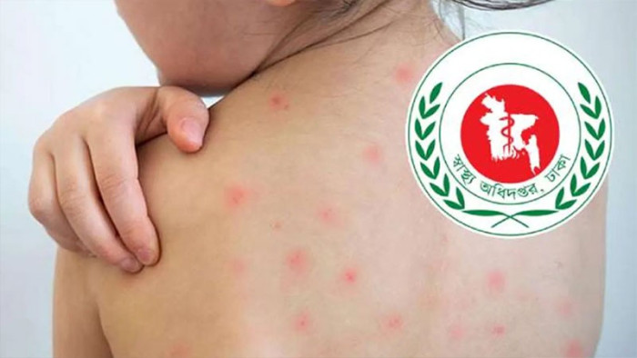 হামের উপসর্গে একদিনে আরও ৫ জনের মৃত্যু