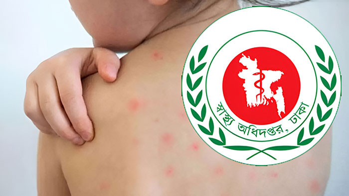 হাম ও উপসর্গে একদিনে ৫ মৃত্যু, নতুন আক্রান্ত ১,০২০